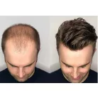 1, PEPI, TOUPEE FÉRFIAK RÉSZÉRE, SZUPER VÉKONY ALAP, 20x25 cm.-es, méretre vágható!