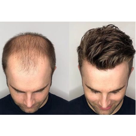 1, PEPI, TOUPEE FÉRFIAK RÉSZÉRE, SZUPER VÉKONY ALAP, 20x25 cm.-es, méretre vágható!